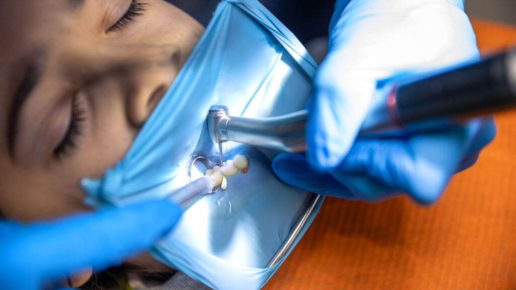 Root canal treatment in Sofia
